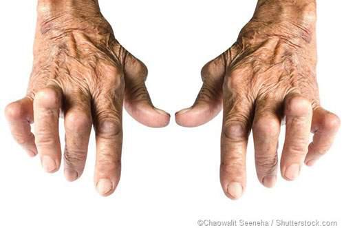 La artritis reumatoide lleva a la pérdida de un gran número de funciones de la vida diaria que afectan el desplazamiento, el cuidado personal, el trabajo y otras actividades básicas.