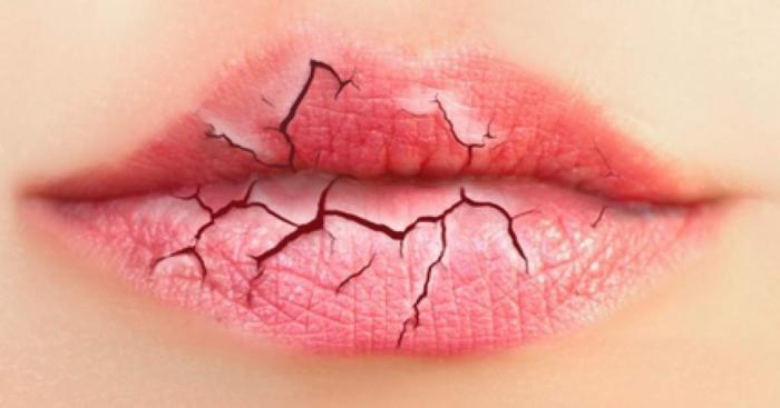 labios agrietados