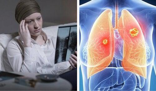 Cancer de pulmón