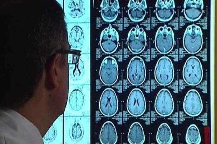 Alzheimer