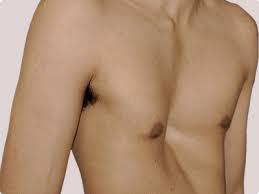 Esternón hundido: ¿Causa de alteraciones respiratorias y cardiacas?