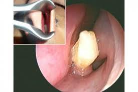 UN DIENTE EN LA NARIZ