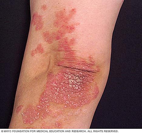 Para aliviar la psoriasis