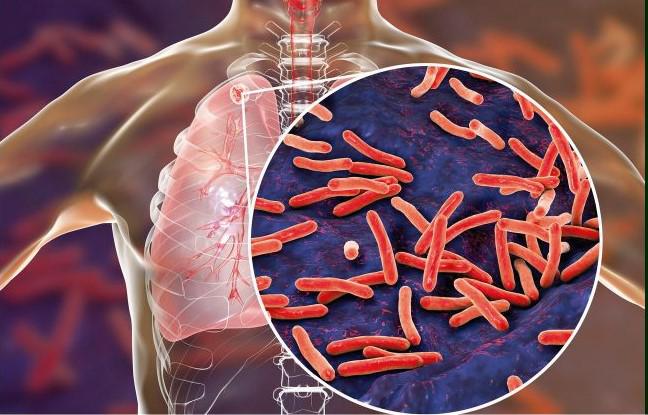 Tuberculosis: preguntas y respuestas