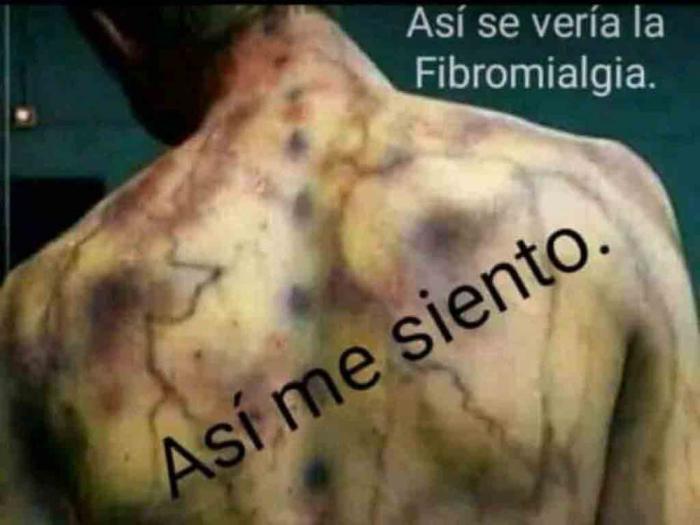 Fibromialgia